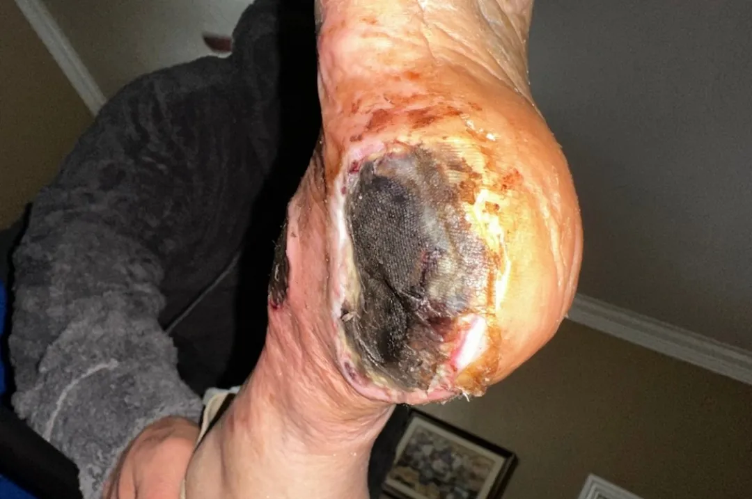 Diabetic foot ulcers